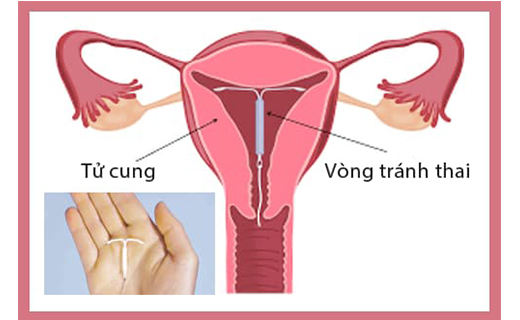 17 tuổi đặt vòng tránh thai được không