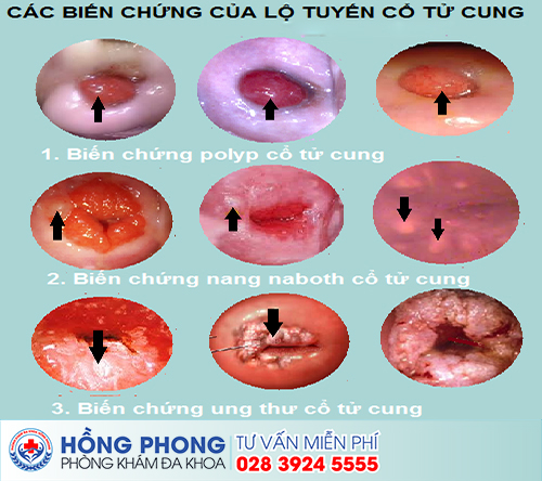 Viêm Lộ Tuyến Cổ Tử Cung Diện Rộng Là Gì