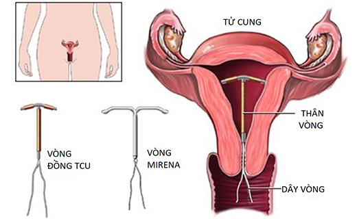 17 tuổi đặt vòng tránh thai được không