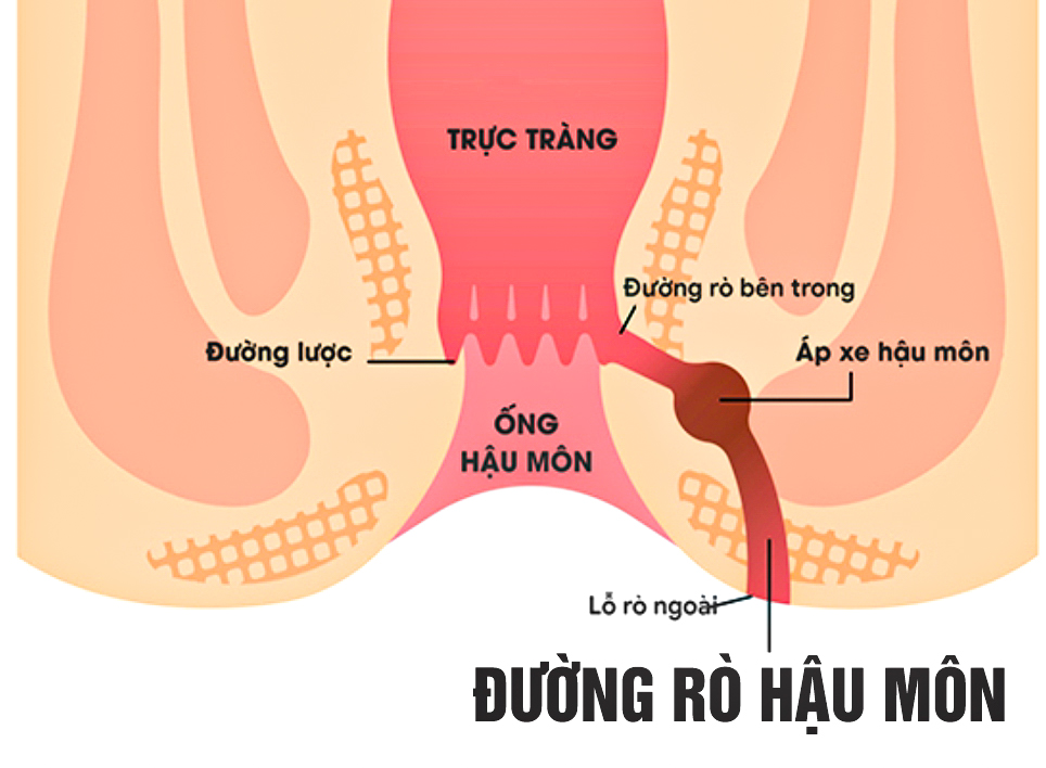 Địa Chỉ Điều Trị Bệnh Rò Hậu Môn