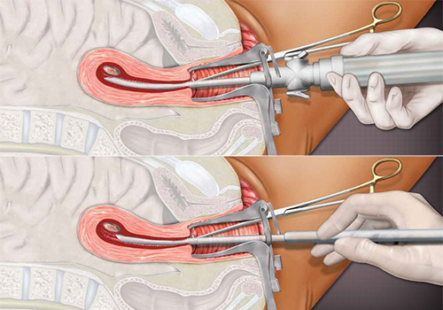 thai 10 tuần tuổi có phá bằng thuốc được không