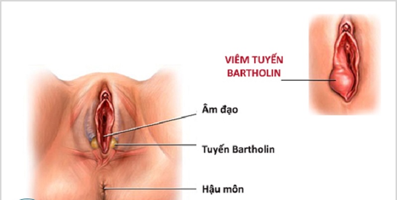 Bệnh Viêm Tuyến Bartholin Có Tự Khỏi Được Không?